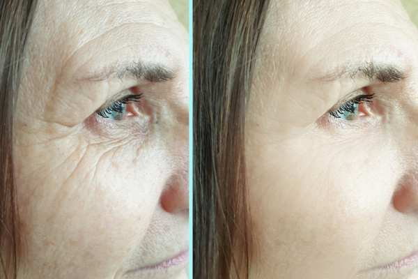 Why Do People Choose HIFU for a Non-Surgical Facelift? 4 How long can HIFU results last Trowbridge?