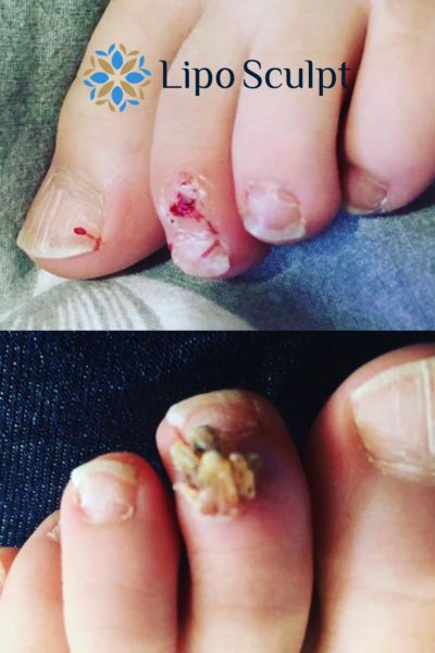 Wart removal customer results from Lipo Sculpt Trowbridge